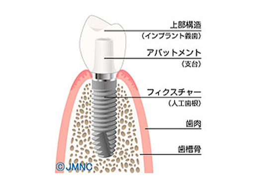 インプラント