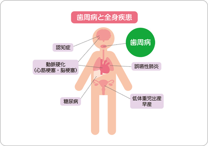 歯周病治療の画像