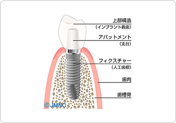 インプラントの画像